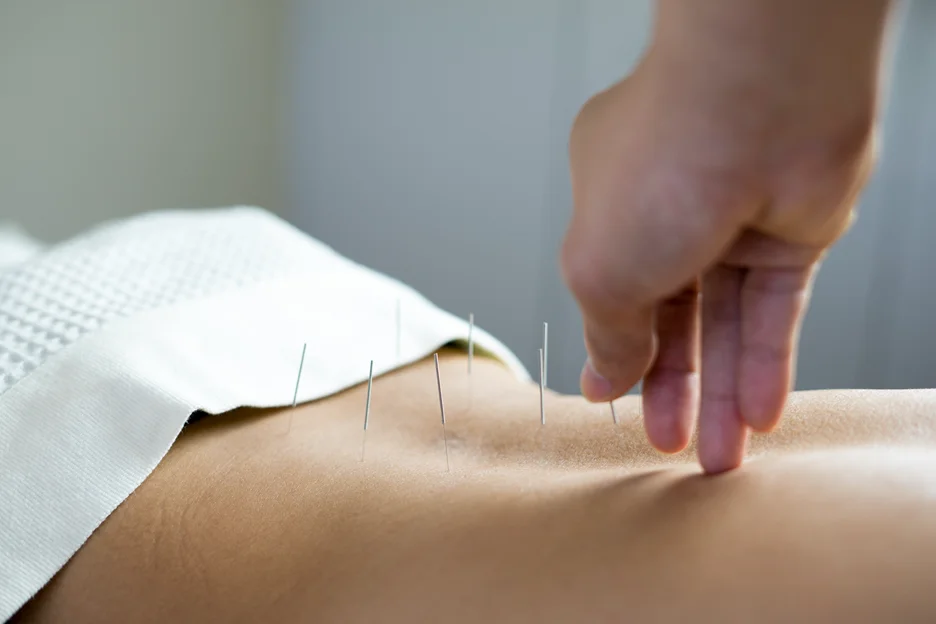 acupuncture for sciatica