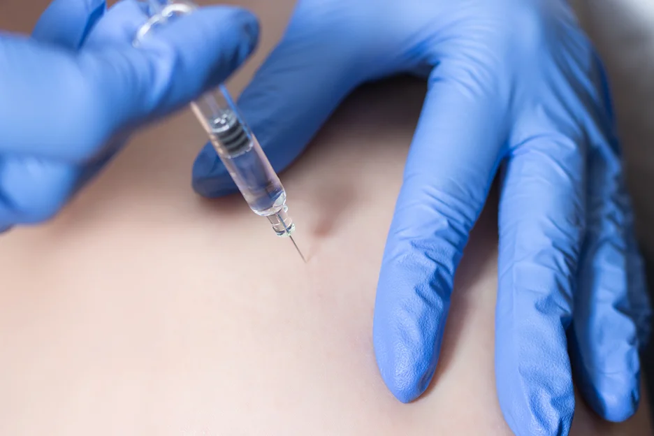 epidural steroid injection for sciatica pain relief