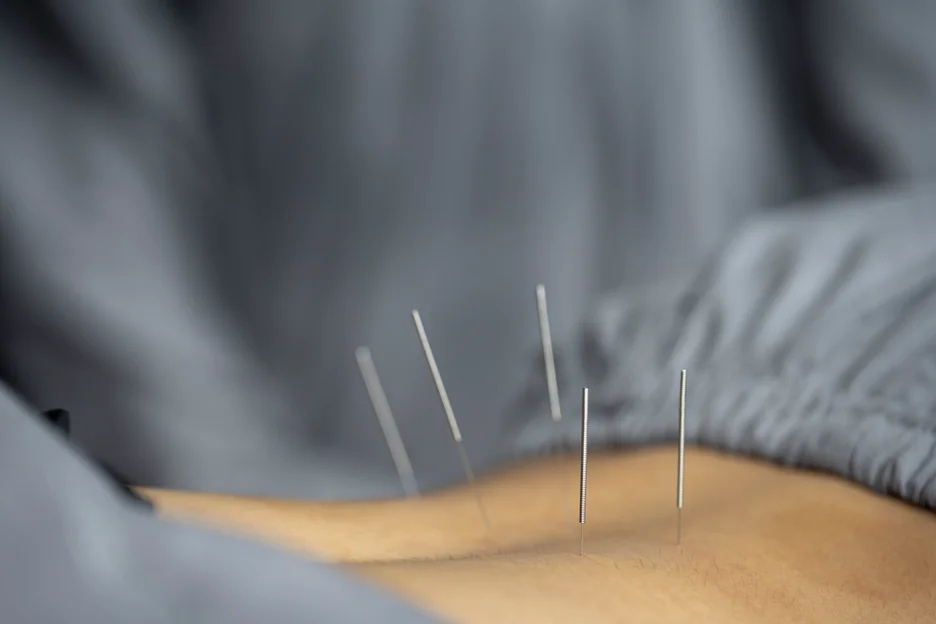 acupuncture for back pain