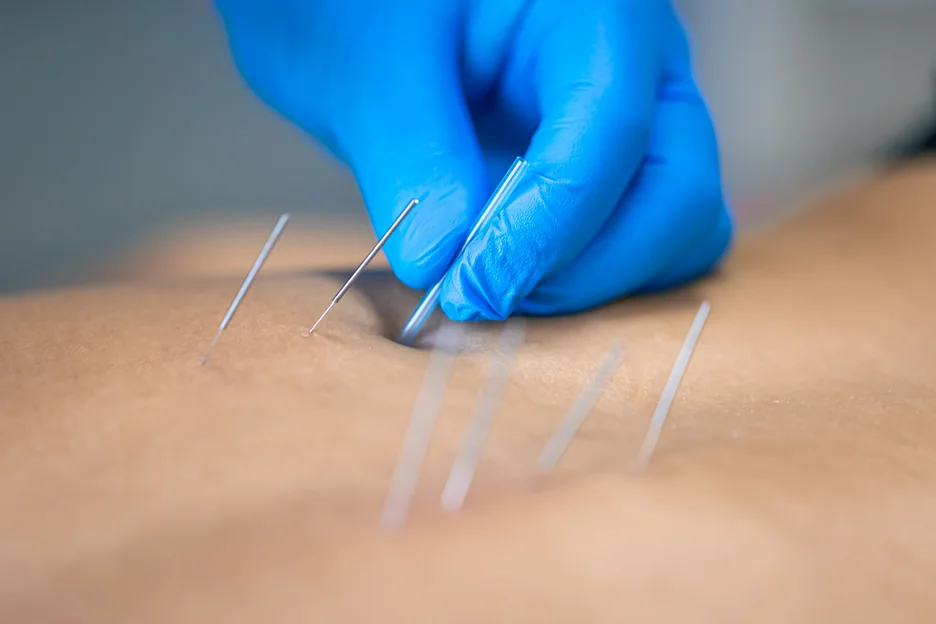 dry-needling-for-sciatica